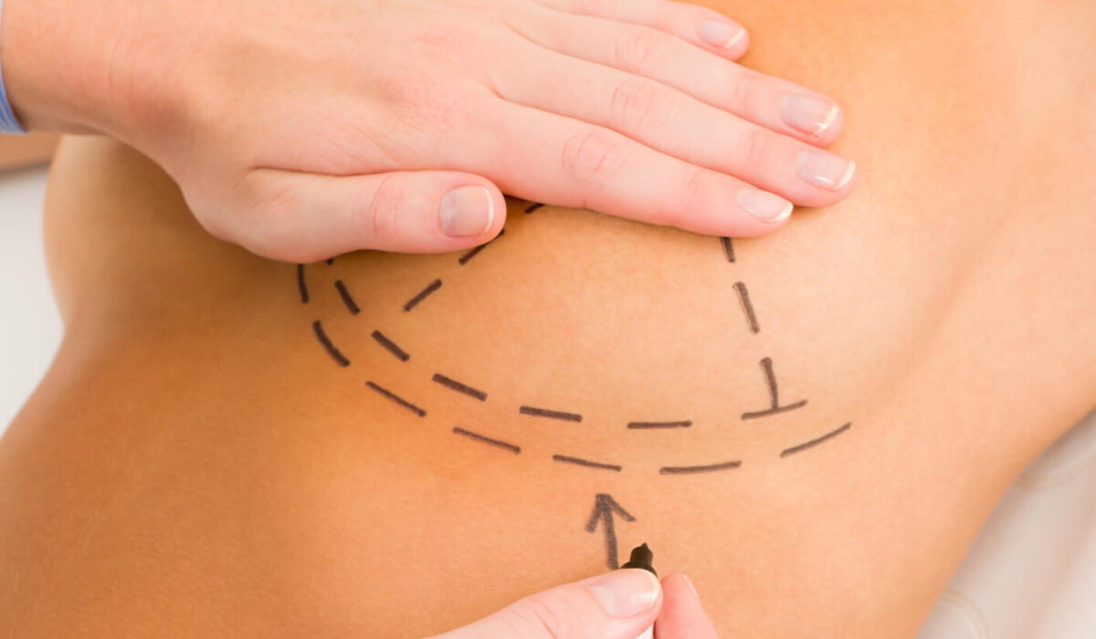 breast reduction questions