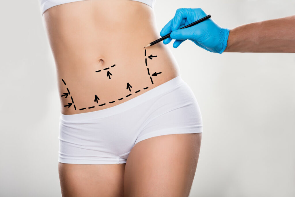 Tummy tuck surgery london