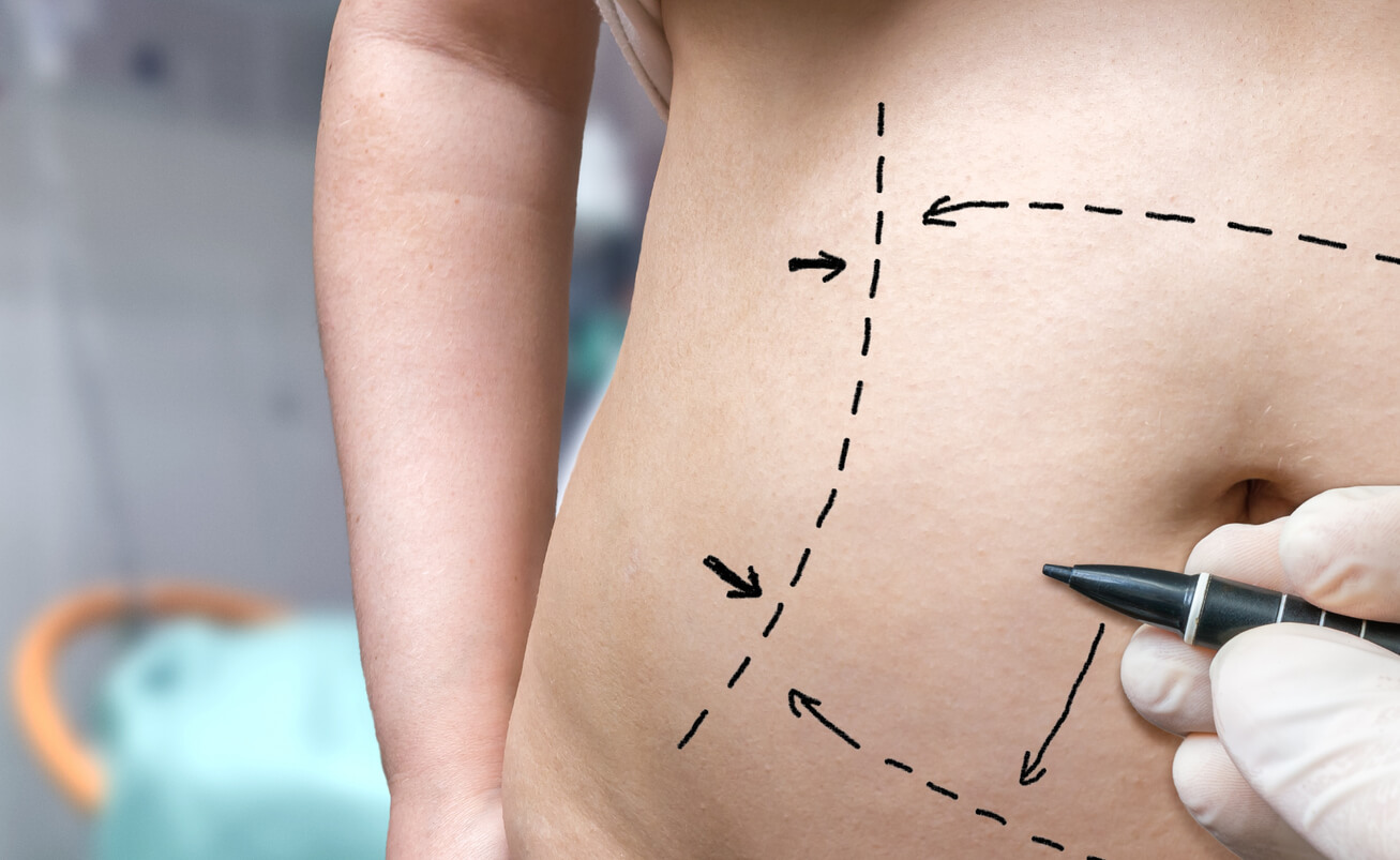 Read more about the article How much is Liposuction in the UK in 2025?