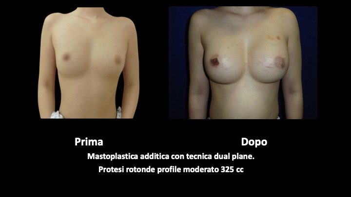 Before and after breast augmentation.