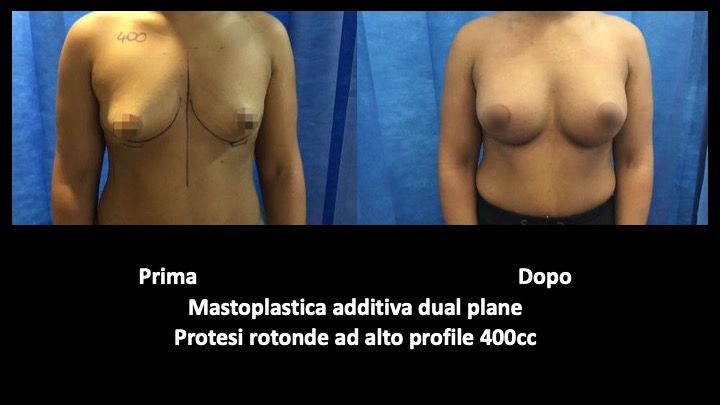 mastoplastica dual plane a roma prima e dopo
