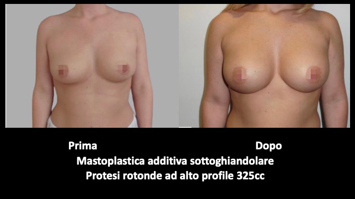 mastoplastica a roma prima e dopo