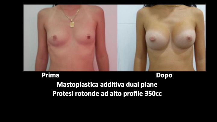 mastoplastica a roma prima e dopo