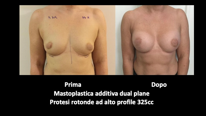 Before and after breast augmentation surgery