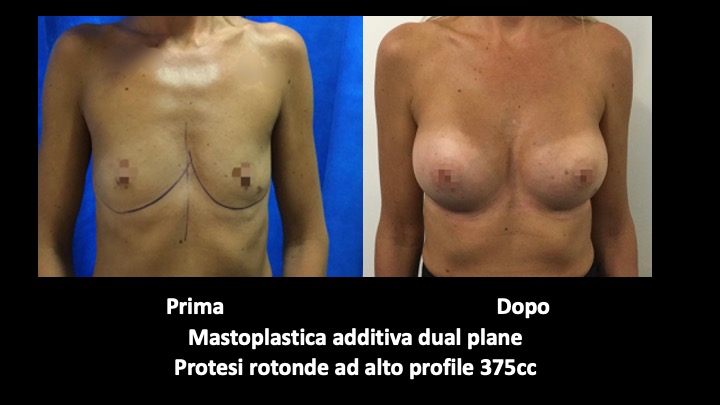 Before and after breast augmentation surgery