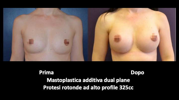 mastoplastica a roma prima e dopo