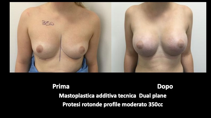 mastoplastica a roma prima e dopo