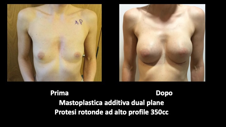 Before and after breast augmentation surgery