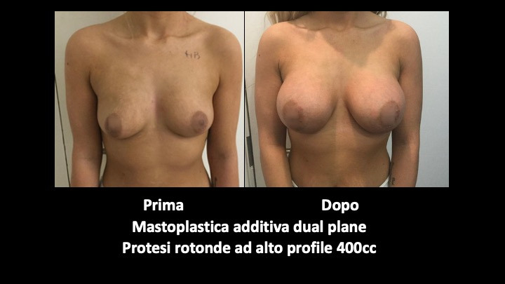 mastoplastica a roma prima e dopo