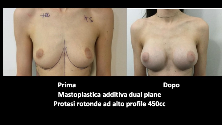 Before and after breast augmentation surgery in london