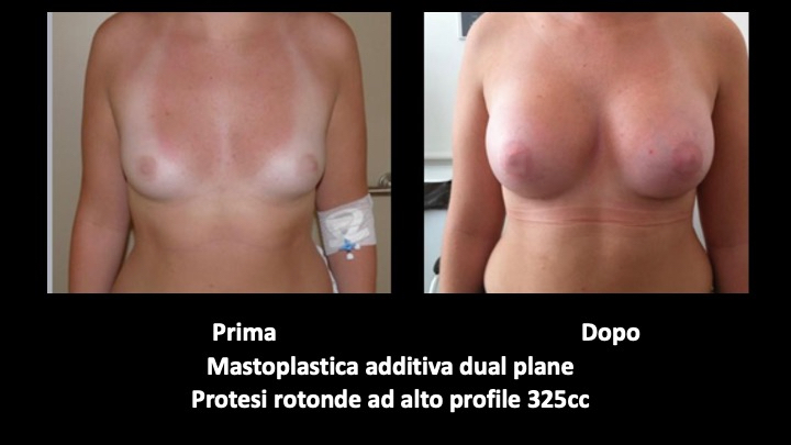 mastoplastica a roma prima e dopo