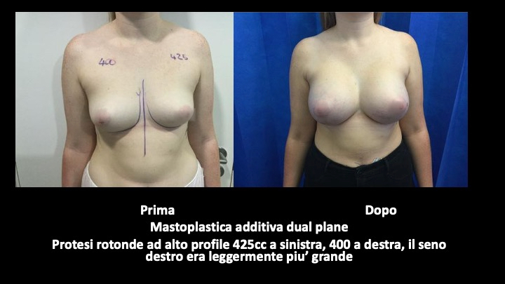 mastoplastica a roma prima e dopo