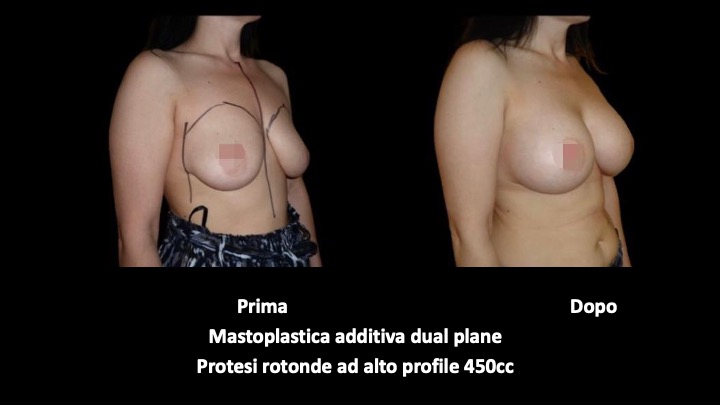 mastoplastica a roma prima e dopo