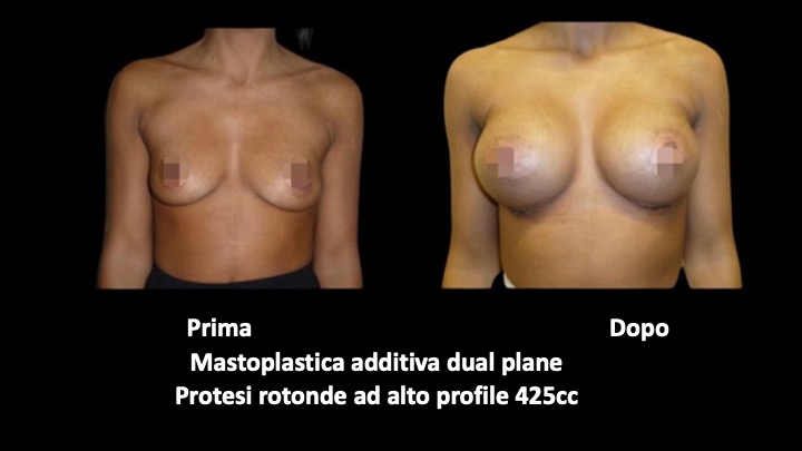 Before and after breast augmentation surgery