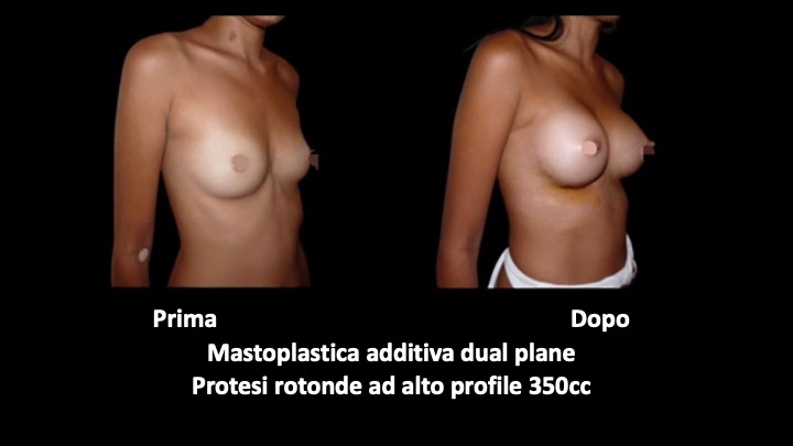 mastoplastica a roma prima e dopo