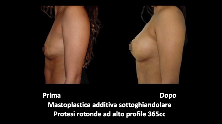 mastoplastica a roma prima e dopo