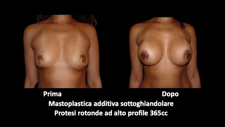 Before and after breast augmentation surgery