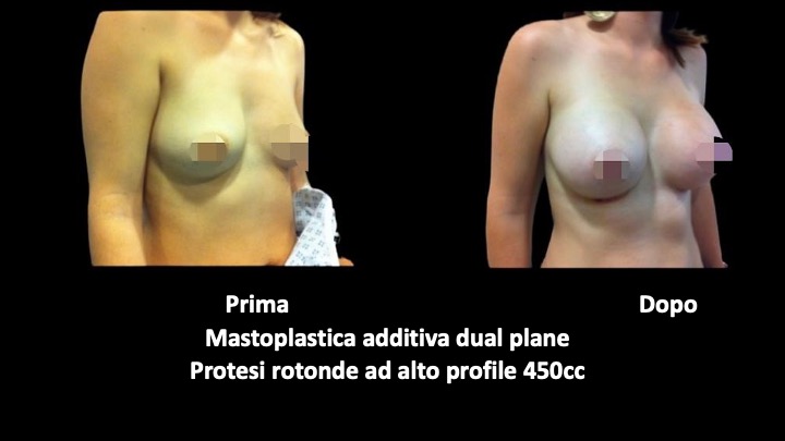 mastoplastica a roma prima e dopo