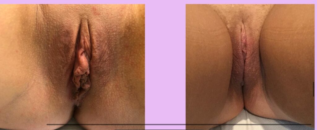 Labia Minora Reduction Explained