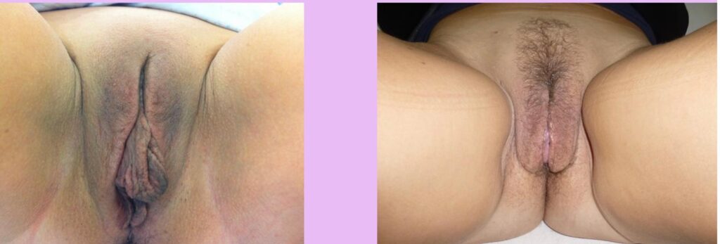labia minora reduction london before after