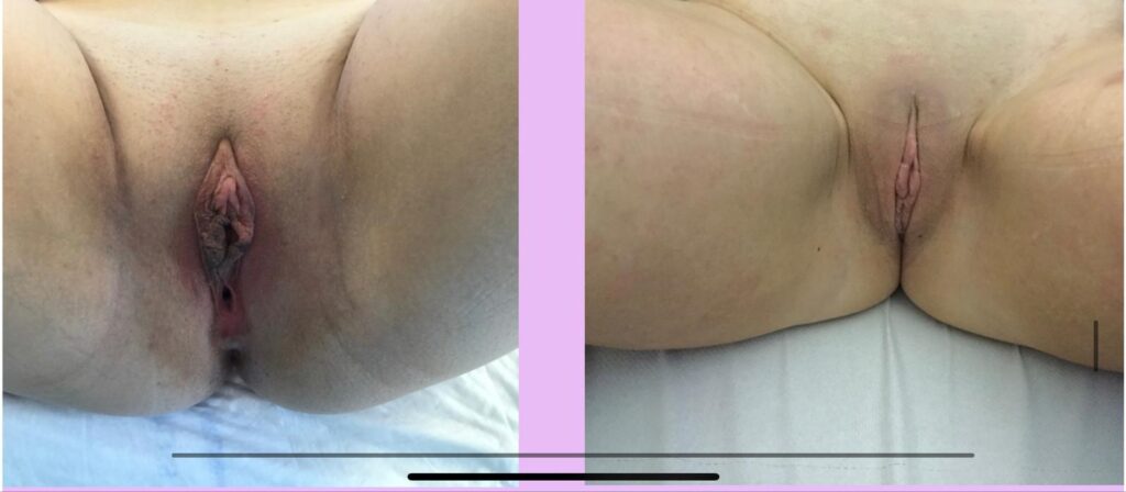 Hypertrophy of the Labia Minora (Inner Lips) is a very common condition