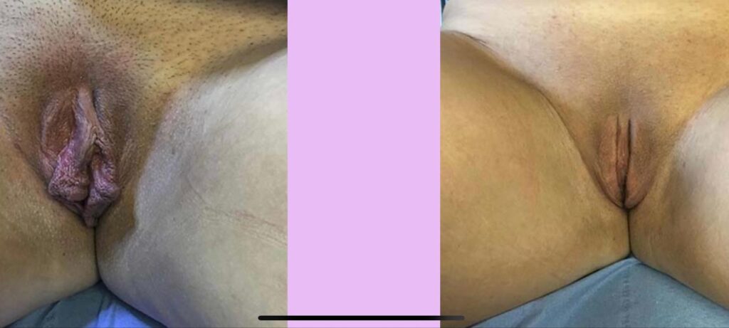labia minora reduction before after