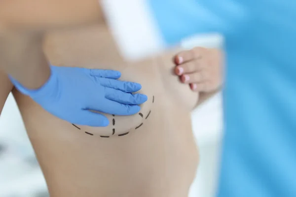 Augmentation Mastopexy London