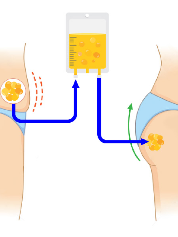 fat-injection-graphic